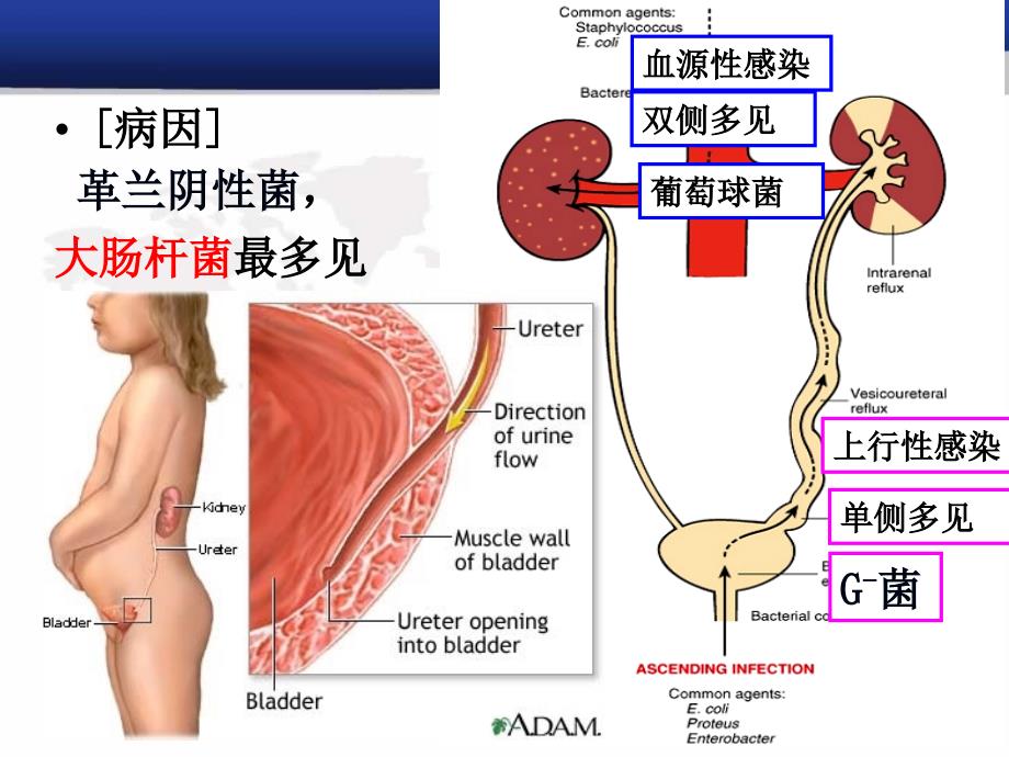 病理学专升本资料：肾盂肾炎_第2页