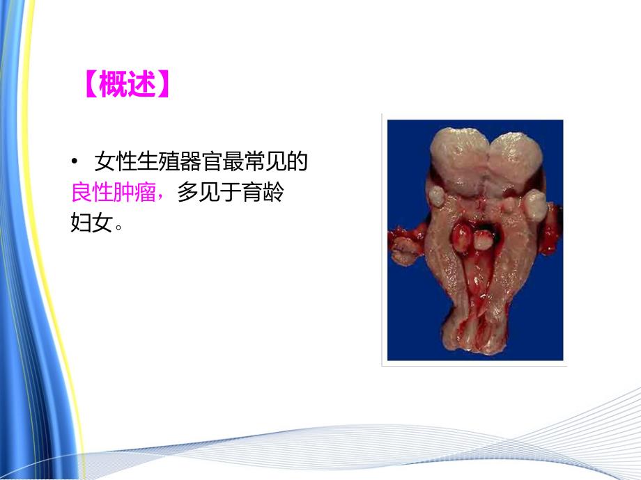 子宫肌瘤病人的术后护理PPT_第3页