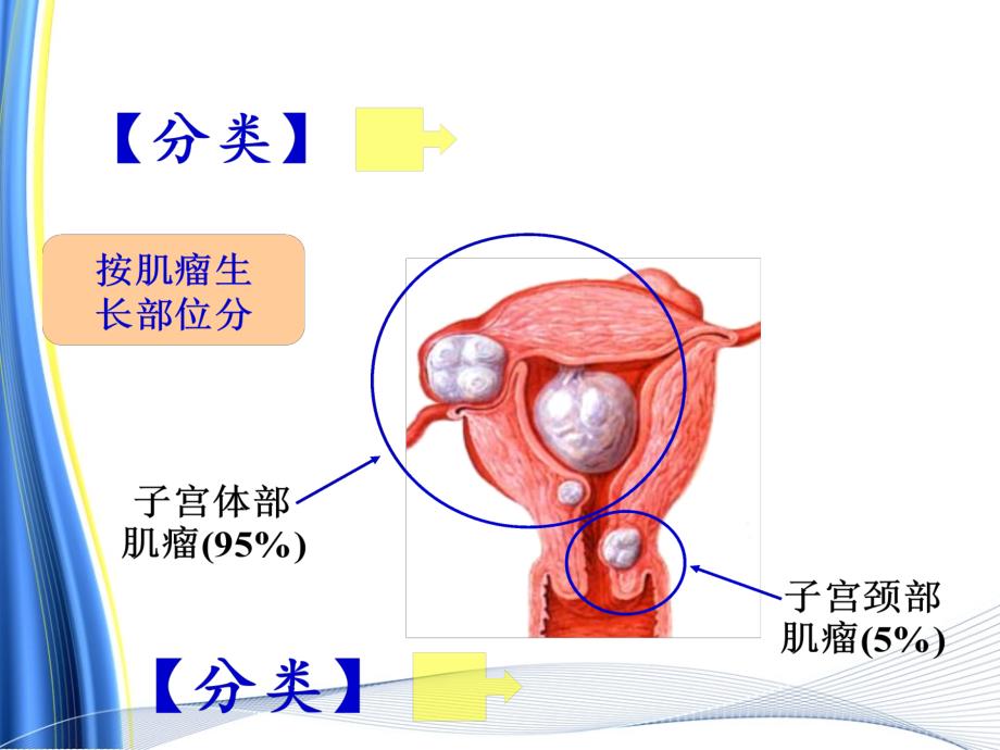 子宫肌瘤病人的术后护理PPT_第4页