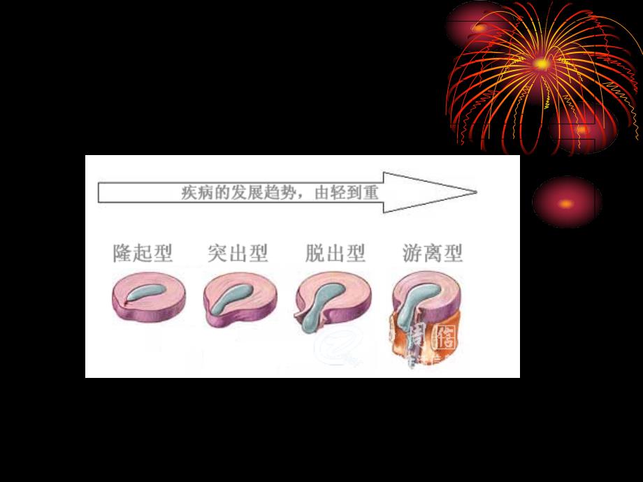 项痹、腰痛-2课件_第3页