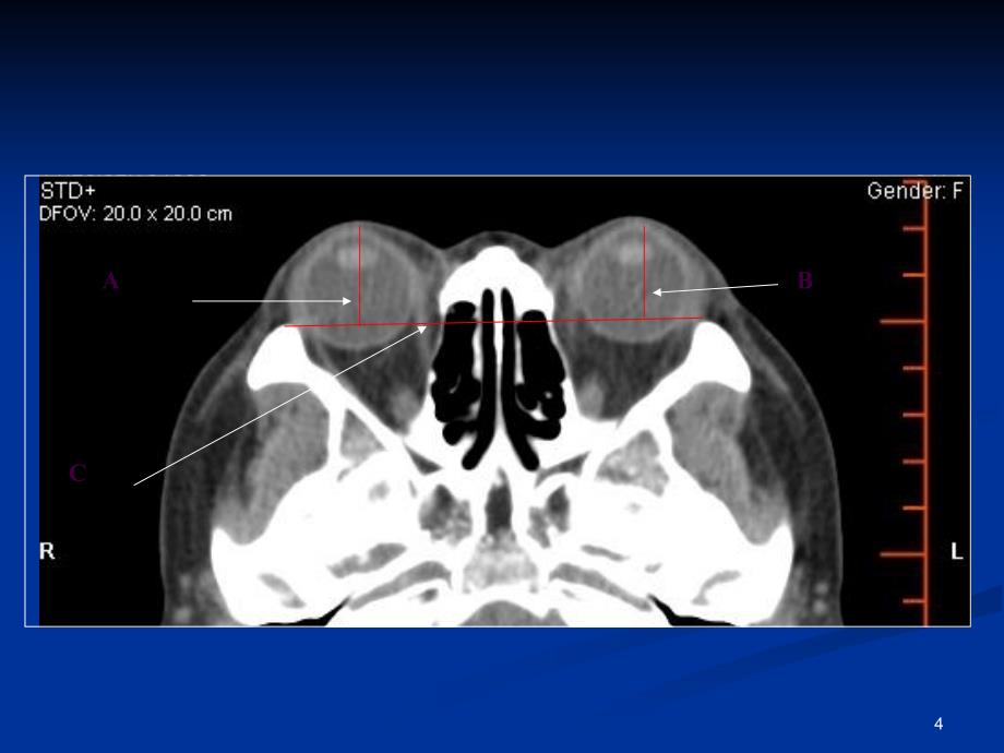 CT测量眼球突出标准ppt课件_第4页