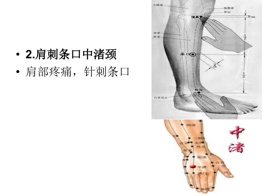 各种疼痛的针灸治疗穴位PPT优质课件_第2页