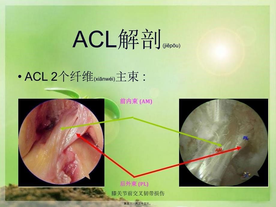 膝关节前交叉韧带损伤课件_第5页