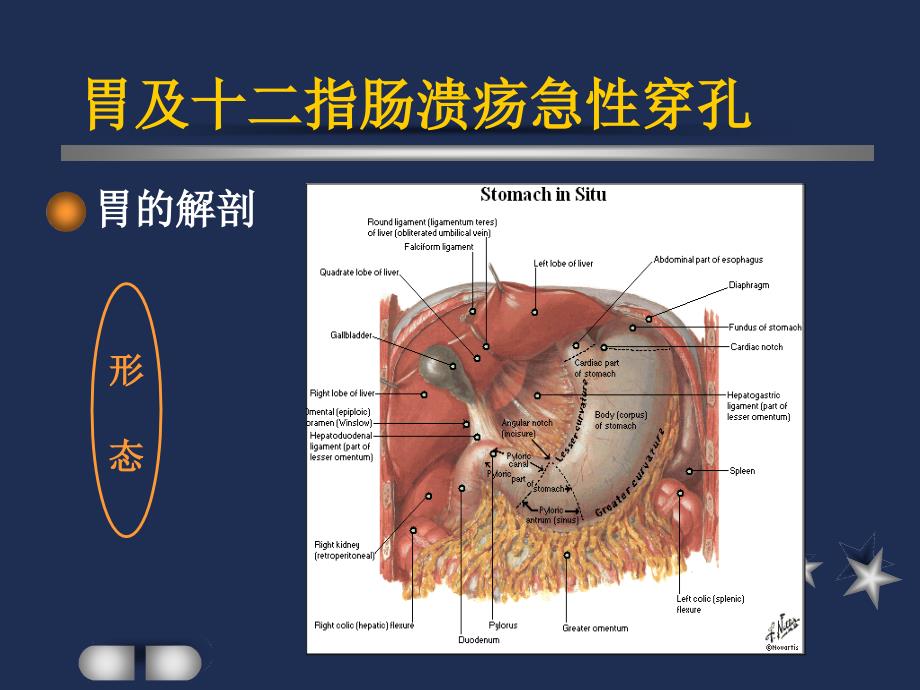 胃及十二指肠溃疡急性穿孔课件_第3页