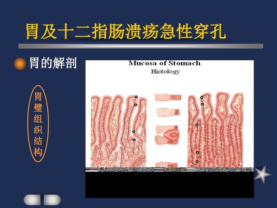 胃及十二指肠溃疡急性穿孔课件_第5页