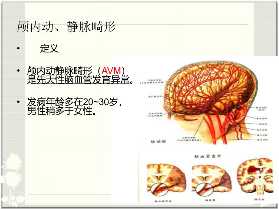 AVM的护理查房_第3页