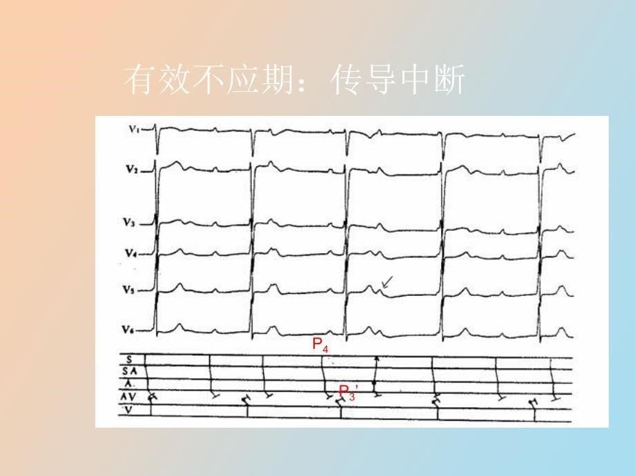 不应期与心电_第5页