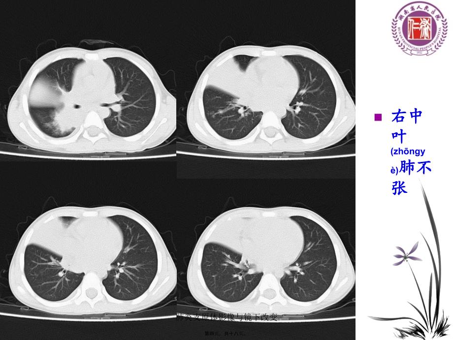 肺炎支原体影像与镜下改变课件_第4页