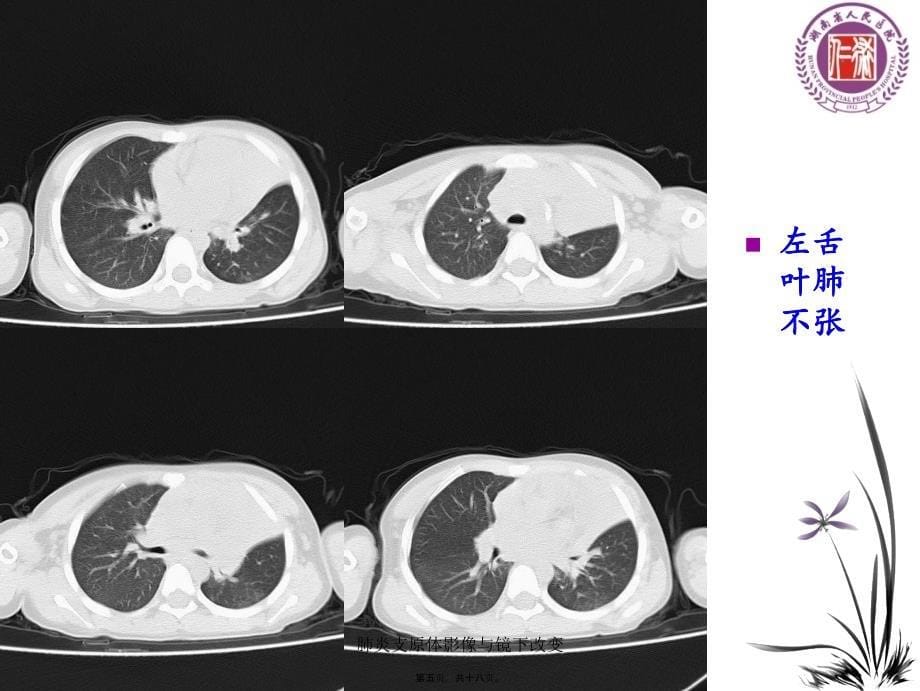 肺炎支原体影像与镜下改变课件_第5页
