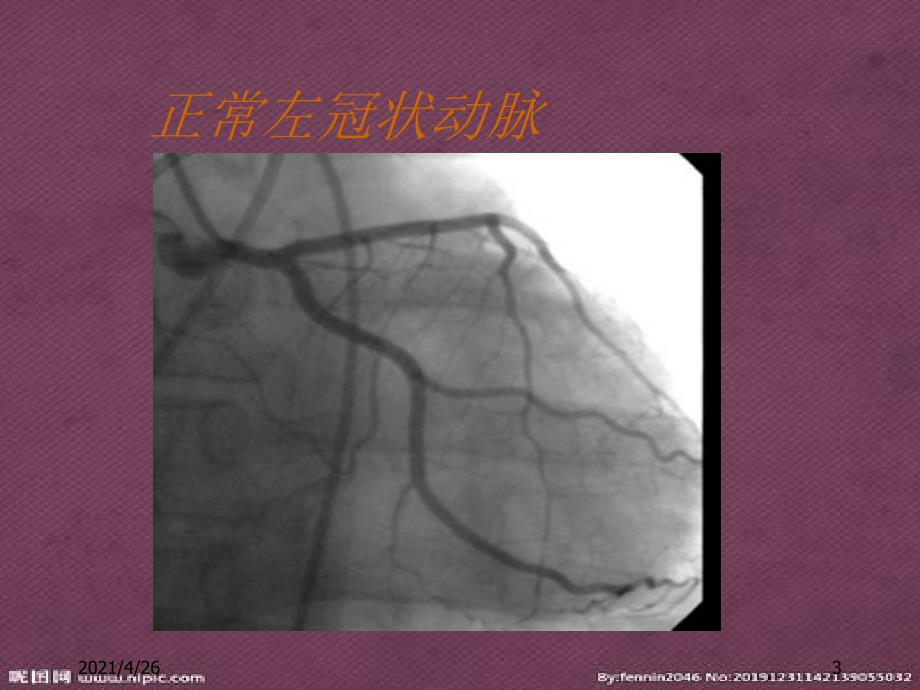 冠状动脉造影结果判定教学课件_第3页