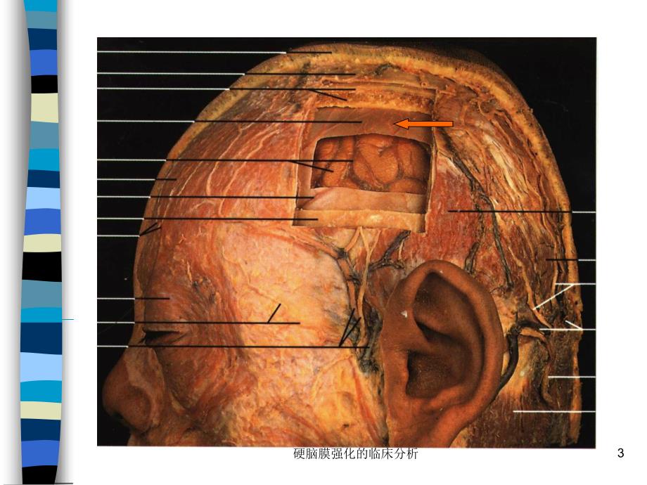 硬脑膜强化的临床分析课件_第3页
