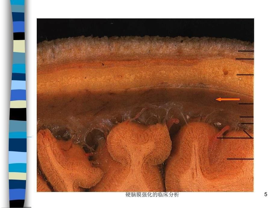 硬脑膜强化的临床分析课件_第5页