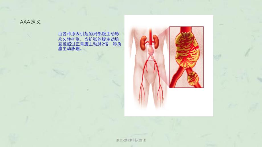 腹主动脉解剖及病理课件_第3页