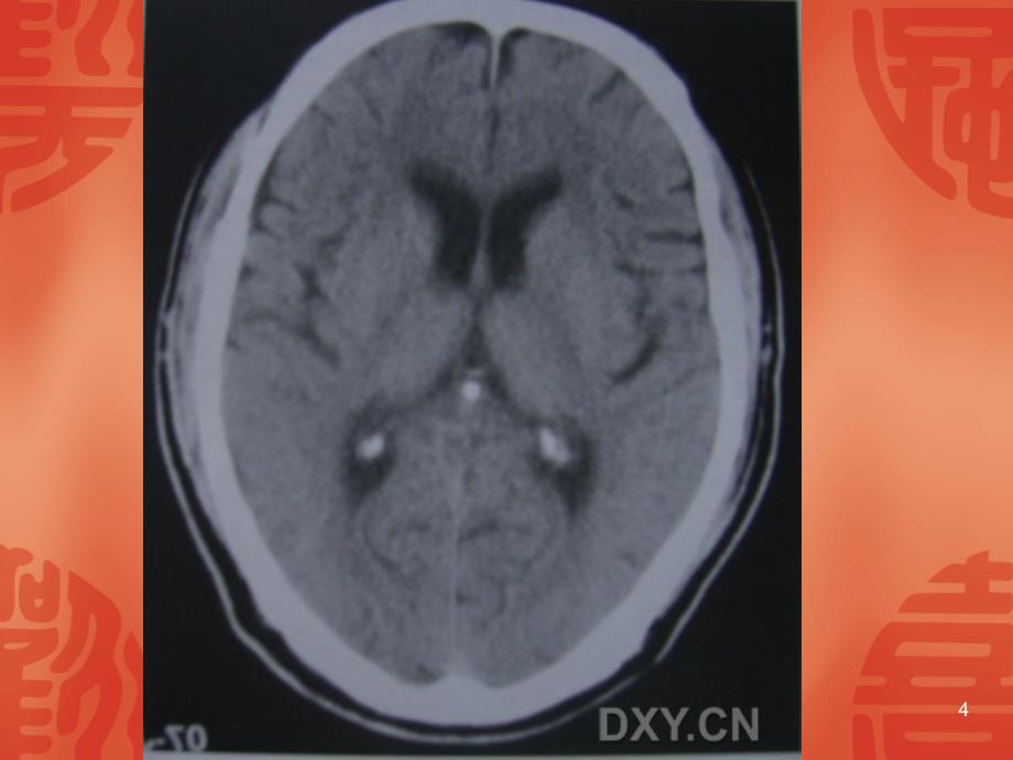 脑部钙化的CT诊断ppt课件_第4页