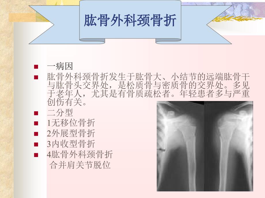 四肢骨折的护理PPT课件_第2页