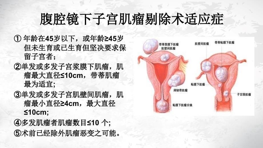 腹腔镜下子宫肌瘤剔除术_第5页