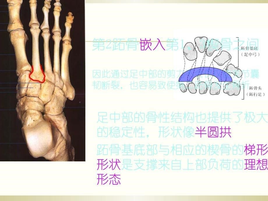 Lisfrance关节损伤PPT课件02_第5页