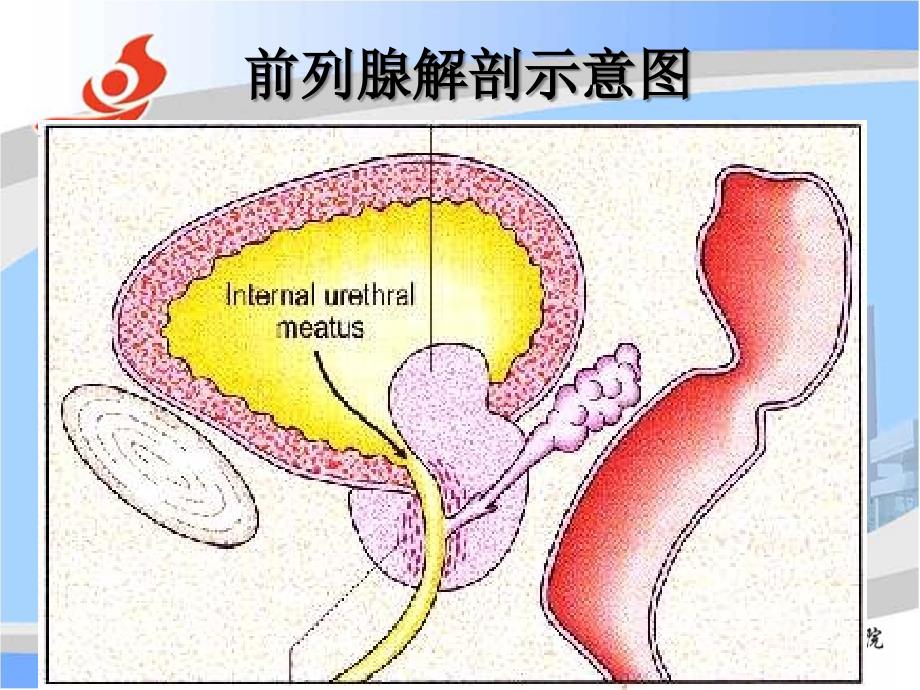 前列腺电切术后并发症的防治_第2页