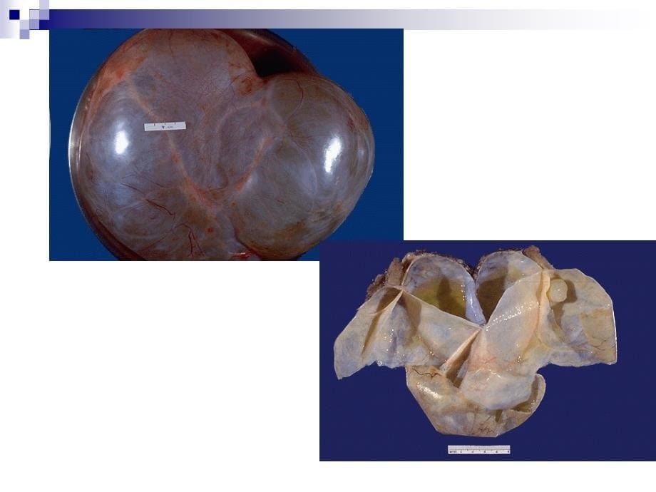 卵巢浆液性囊腺瘤_第5页