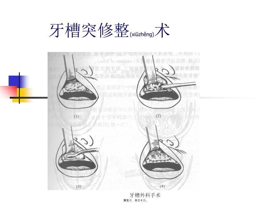 牙槽外科手术课件_第5页