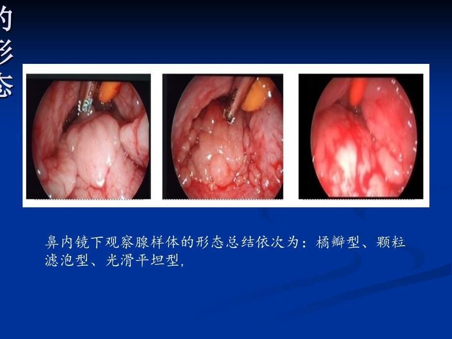 腺样体肥大与分泌性中耳炎_第5页