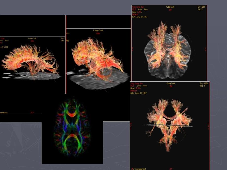 MRI弥散张量成像DTI的基本原理及其在中枢神经系统中的应用医学影像学课件_第3页