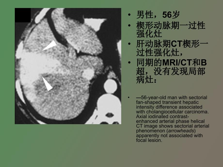 肝脏动脉期一过性强化灶_第3页