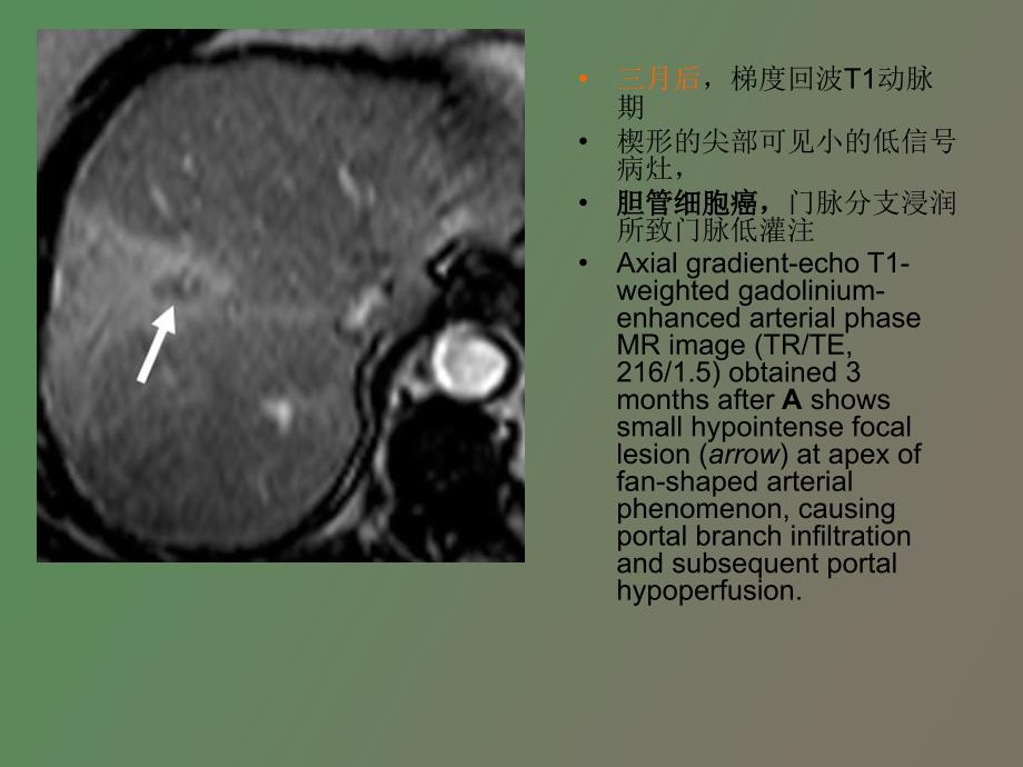 肝脏动脉期一过性强化灶_第4页