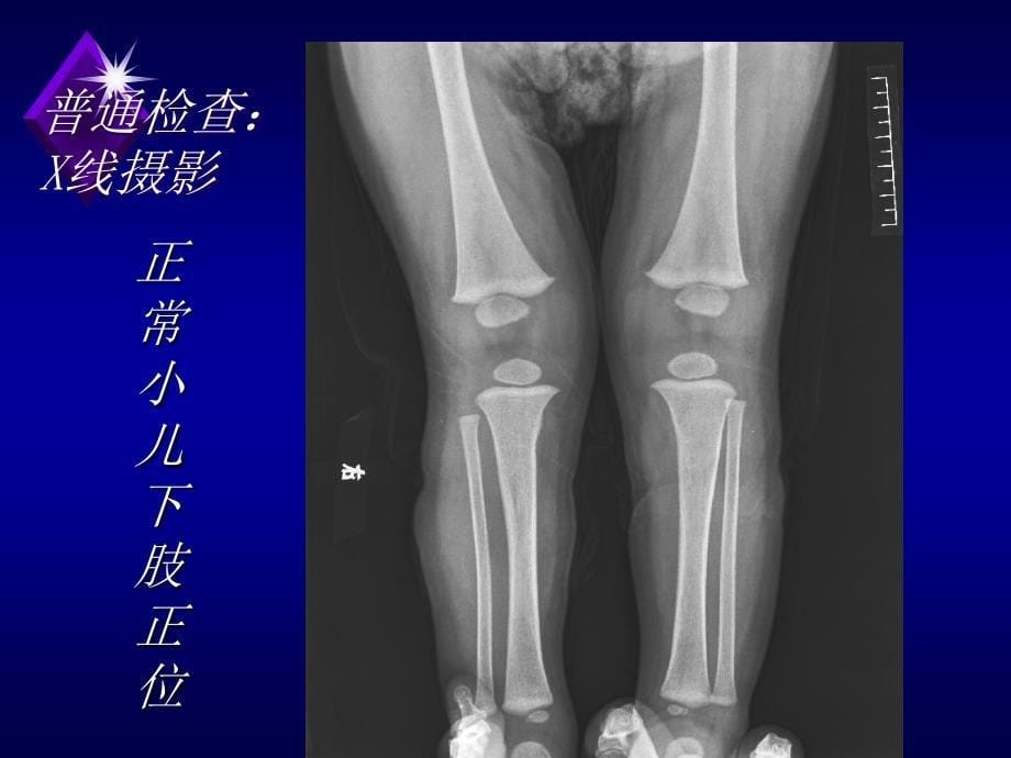 《医学影像学》课件：第9章骨骼系统教学(3学时)_第5页