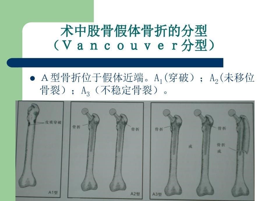 假体周围骨折概况课件_第5页