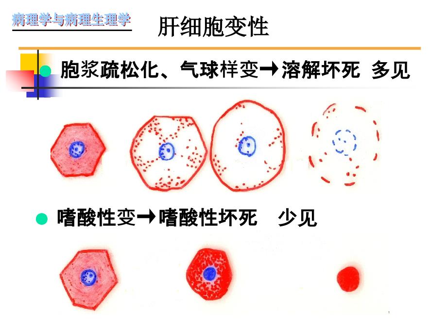 病毒性肝炎肝硬化_第4页