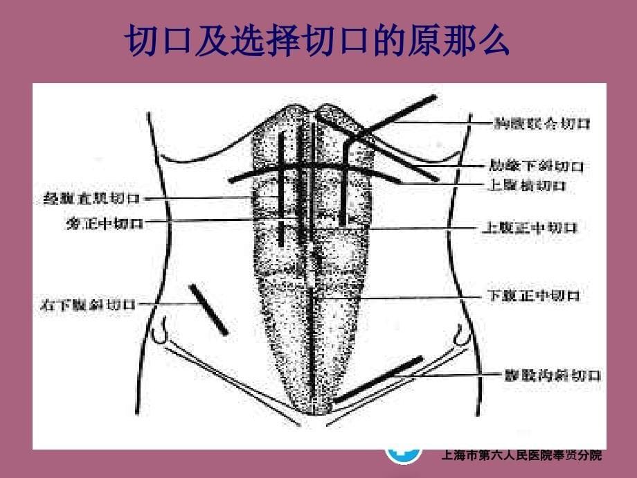 腹部切口选择讲课ppt课件_第5页