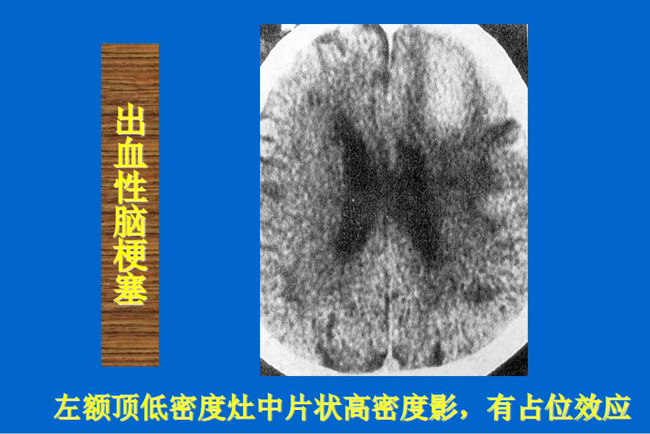 急性脑血管病的影像诊断_第1页