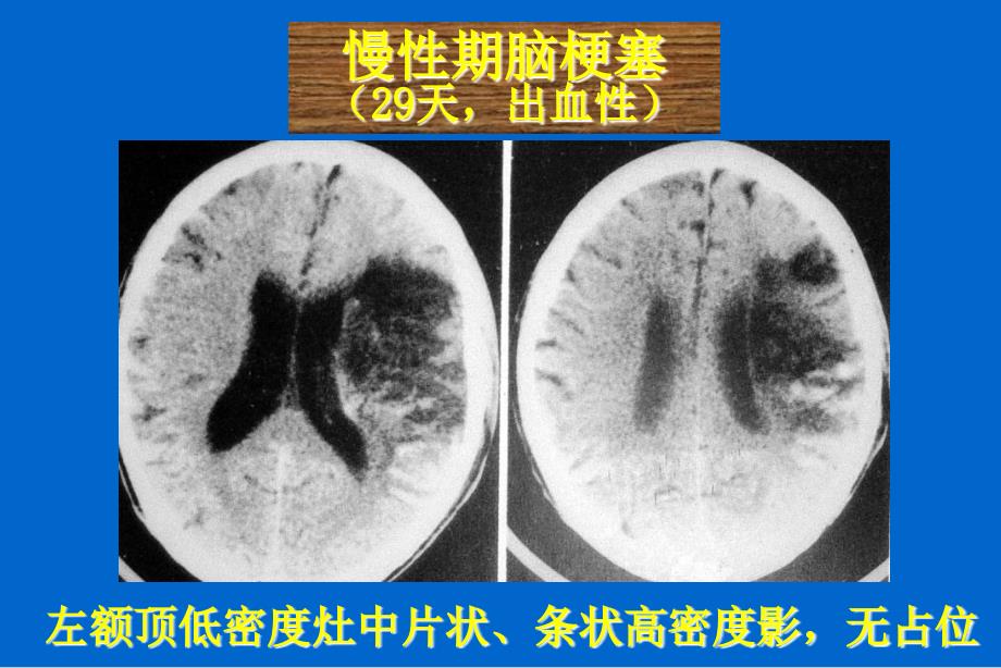 急性脑血管病的影像诊断_第2页