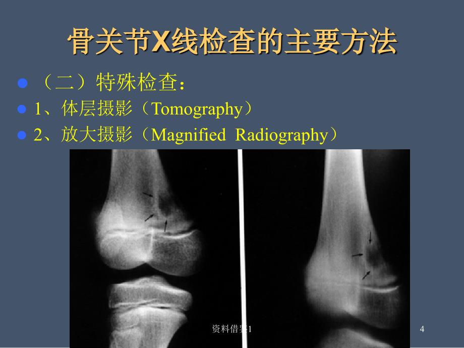 骨关节x线诊断-正常异常表现和骨折（行业荟萃）_第4页