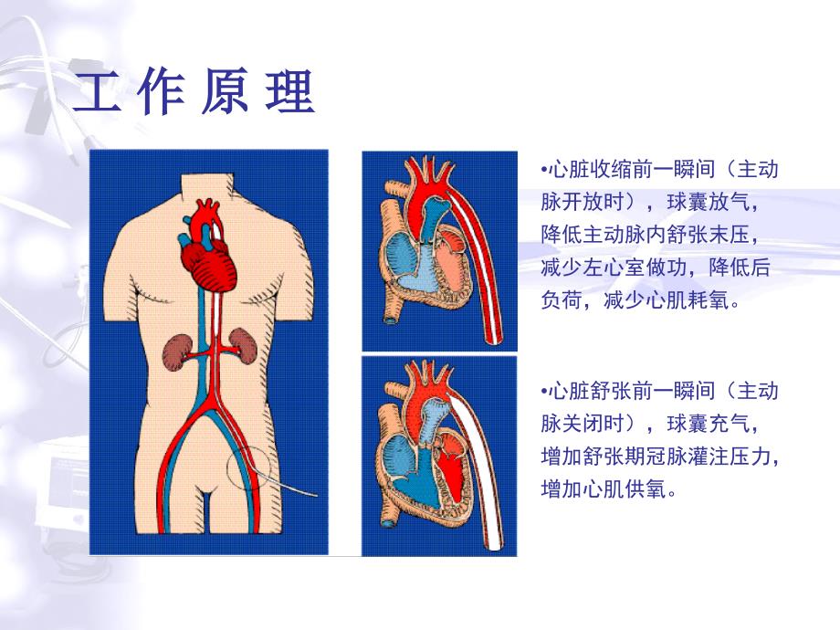 IABP总汇(ARROW)_第4页