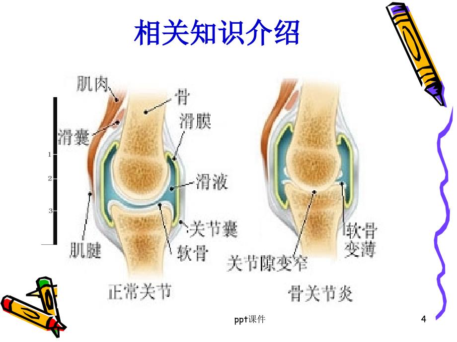 骨性关节炎病人的护理查房课件_第4页