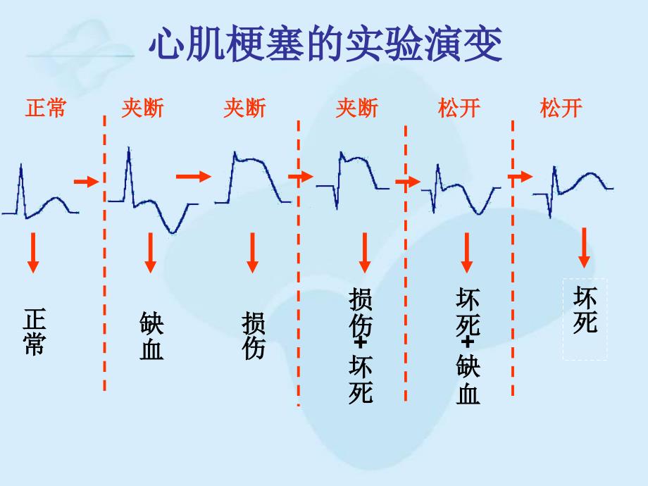 心肌梗死的心电图改变_第3页