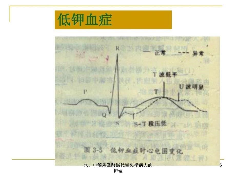 水电解质及酸碱代谢失衡病人的护理课件_第5页