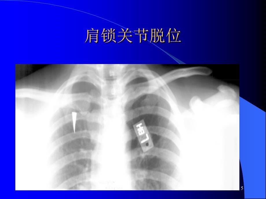 (医学课件)骨科常见疾病的X线表现骨折脱位  ppt演示课件_第5页