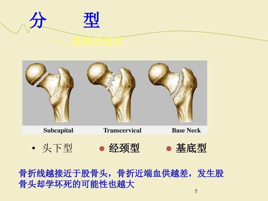 股骨颈骨折治疗选择ppt课件(1)_第5页