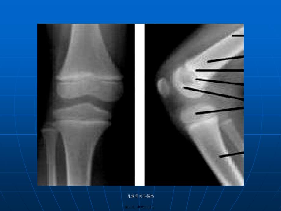 儿童骨关节损伤课件_第3页