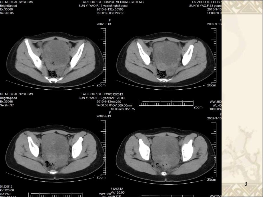 卵巢囊肿蒂扭转CT课件_第3页