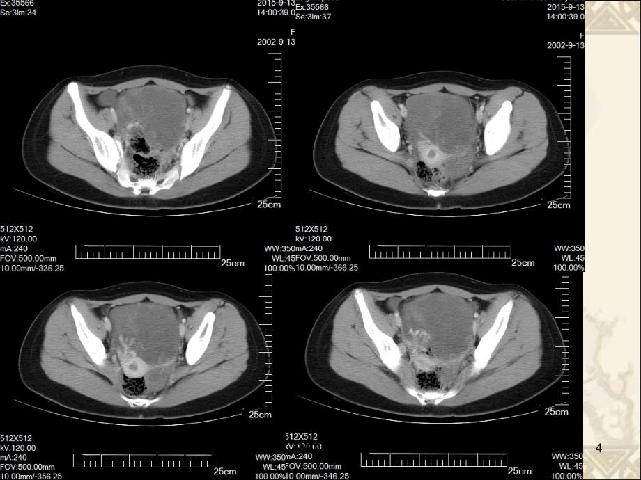 卵巢囊肿蒂扭转CT课件_第4页