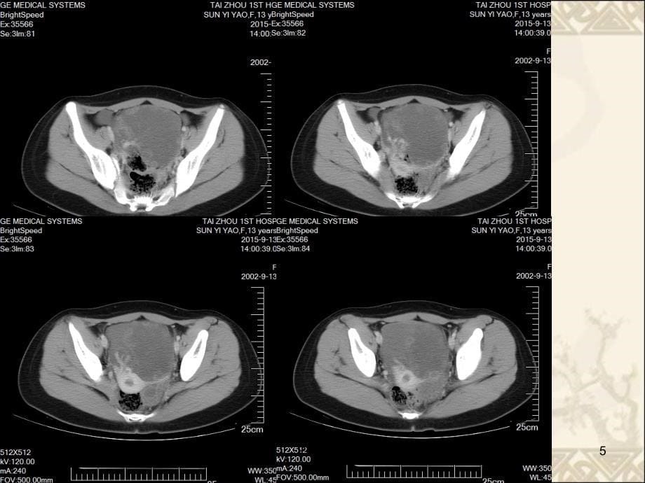 卵巢囊肿蒂扭转CT课件_第5页