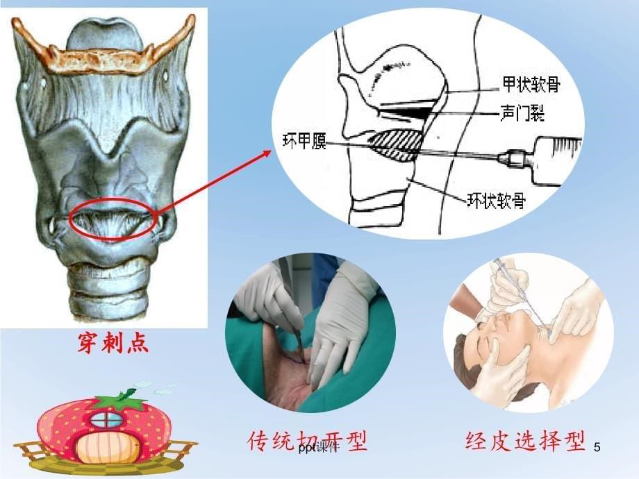 环甲膜穿刺课件_第5页