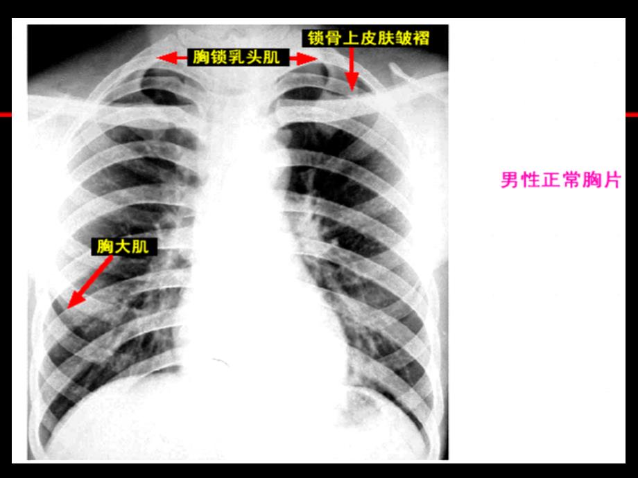 胸片阅读必看严选材料_第4页