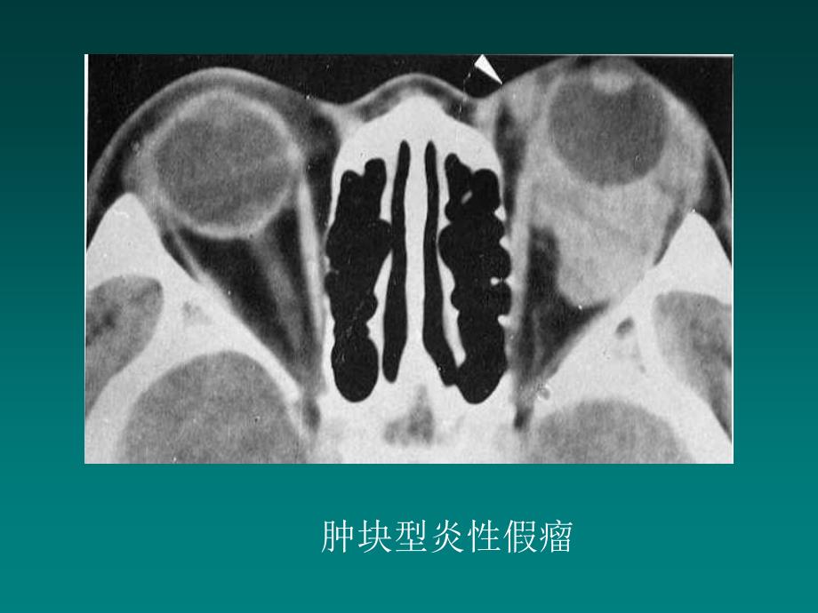 五官头颈部MRIPPT课件_第4页