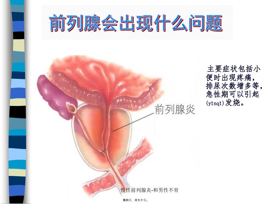 慢性前列腺炎-和男性不育课件_第4页