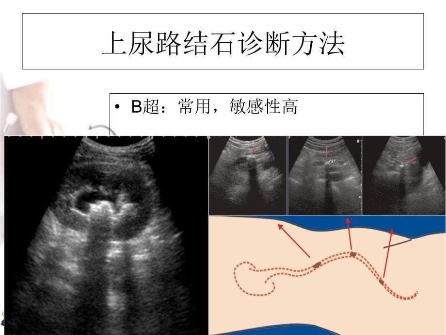 上尿结石诊断方法课件文档资料_第5页